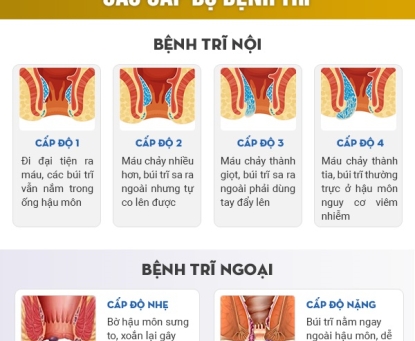 Có bao nhiêu loại trĩ và chúng khác nhau thế nào?